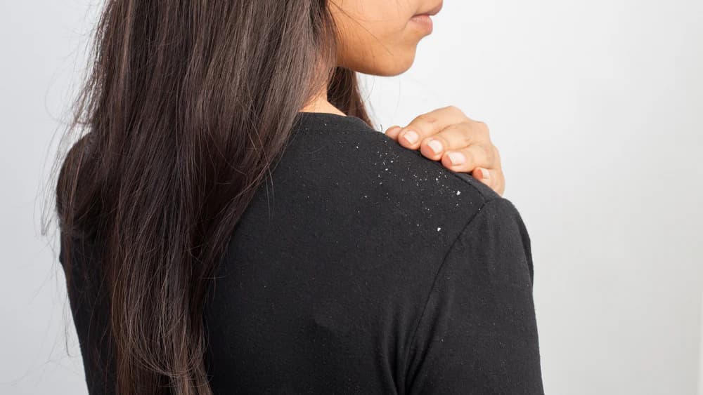 Yao Secret Dealing With Dandruff: Natural Antibacterial Treatments